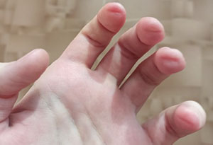 пальцы после игры на гитаре